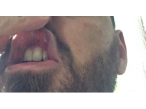 10 Kişinin Yaralandığı Kız İsteme Kavgasındaki Damat Adayı Konuştu