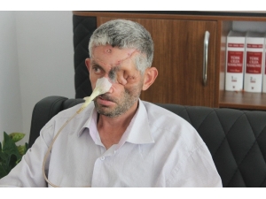 Dişini Çektirdi, Gözünü Kaybetti