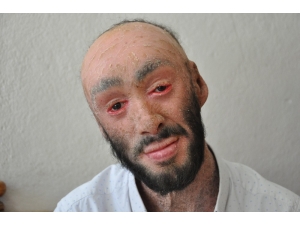 Cilt Hastası Töre İyileşmek İstiyor