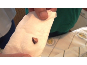 Çorba İçerken Akciğerine Kaçan Kemik 3 Yıl Sonra Fark Edildi