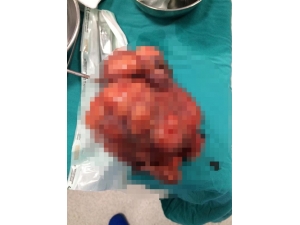 Kasık Ağrısı Şikayetiyle Geldi, Karnından 2 Kg’lık Ur Çıktı