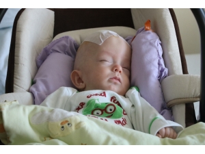 Prematüre Bebeğe Beyin Ameliyatı