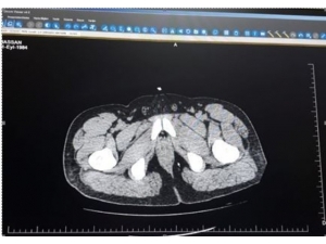 İran’dan Midesinde Eroin Getiren Şahsı Polis Yakaladı