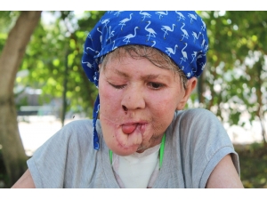 Çenesinde Çıkan Sivilce Hayatını Kararttı, Kızının Derdine Düştü