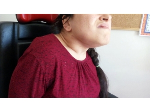 26 Yaşındaki Engelli Hastanın Çenesinin Altından 38 Cm Büyüklüğünde Tümör Çıkarıldı