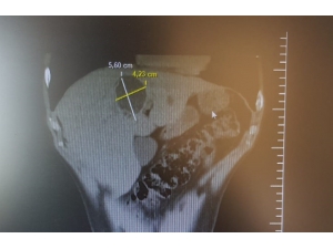 Karaciğerideki Kistten 3 Saatlik Operasyonla Kurtuldu