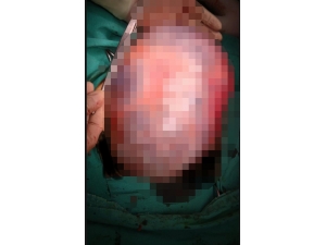 Genç Kadının Karnındaki 30 Santimetrelik Kist Operasyonla Alındı