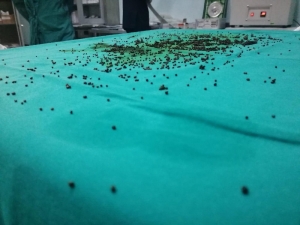 Safra Kesesinden 3 Bin 765 Taş Çıkarıldı