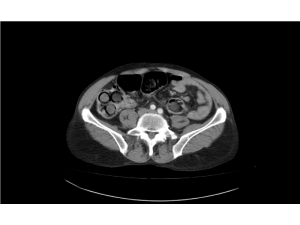 İran Uyruklu Zanlı, Yuttuğu 48 Paket Eroini Hastanede Bir Haftada Çıkardı
