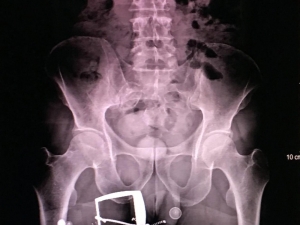 İranlı Kadının Şok Eden Uyuşturucu Taşıma Yöntemini Polis Fark Etti