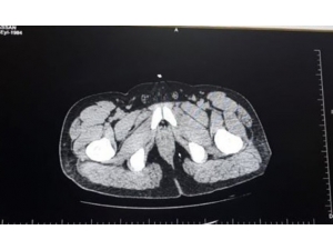 İki Yabancı Uyruklu Yolcunun Mide Ve Bağırsaklarında Uyuşturucu Taşıdıkları Ortaya Çıktı