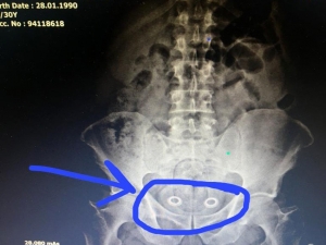 İran Uyruklu Bir Kişinin Mide Ve Bağırsağından Uyuşturucu Çıktı