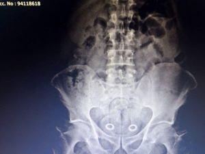 Kars’a Uyuşturucuyu Bağırsaklarında Sokarken Yakalanmıştı