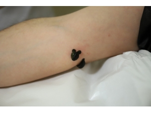 Varis Ve Eklem Ağrılarına Sülük Tedavisi