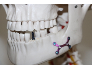 Otomobil Parçası Üreten Türk Firması, Diş İmplantında Dışa Bağımlılığa Son Verdi