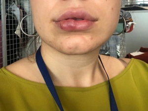 Dudak Dolgusu Yaptırdı Hayatı Karardı