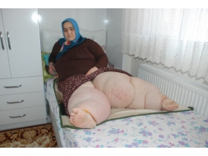 Trafik Kazası Sonrasında Bacakları Şişen Kadın Yaşam Savaşı Veriyor