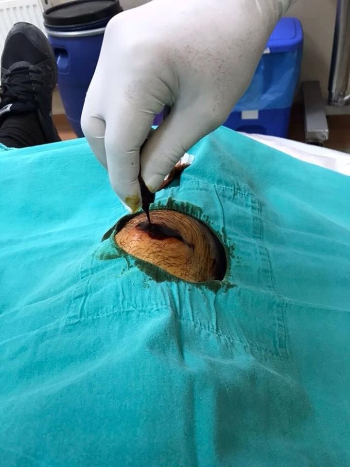 Kaldırım Taşının Azizliğine Uğradı Ayağına Altı Dikiş Atıldı