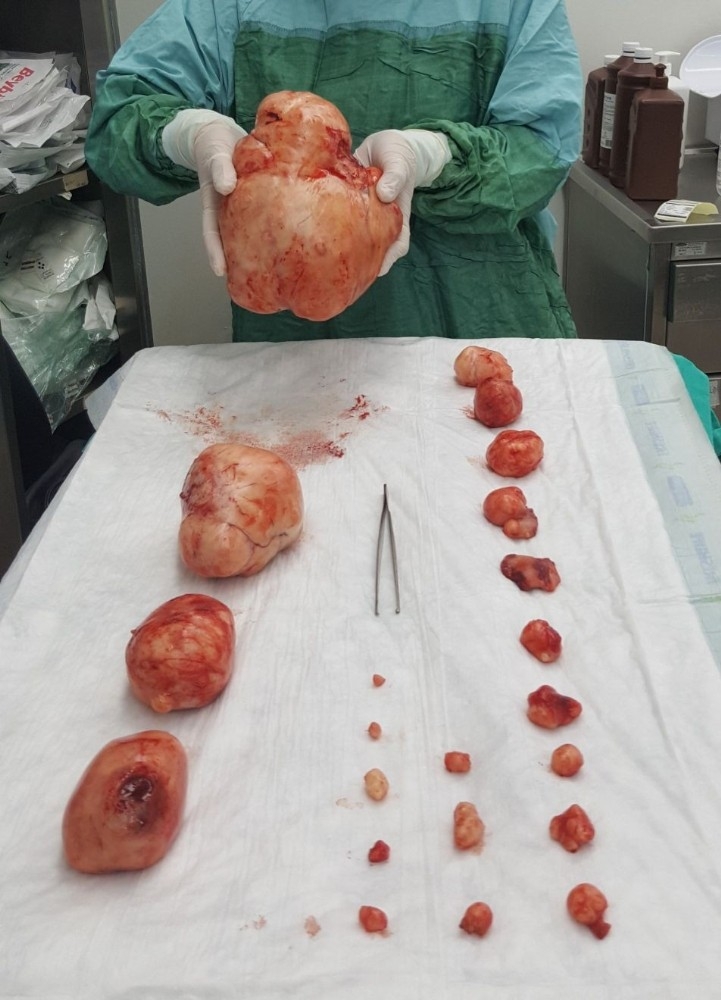 36 Yaşındaki Kadının Karnından 5 Kilogram Ur Çıkarıldı