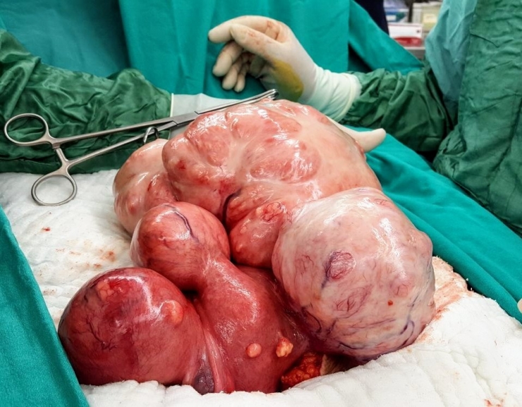 36 Yaşındaki Kadının Karnından 5 Kilogram Ur Çıkarıldı