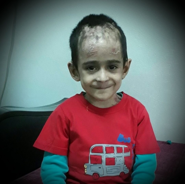 Kelebek Hastalığı Çocukların Hayatlarını Çalıyor