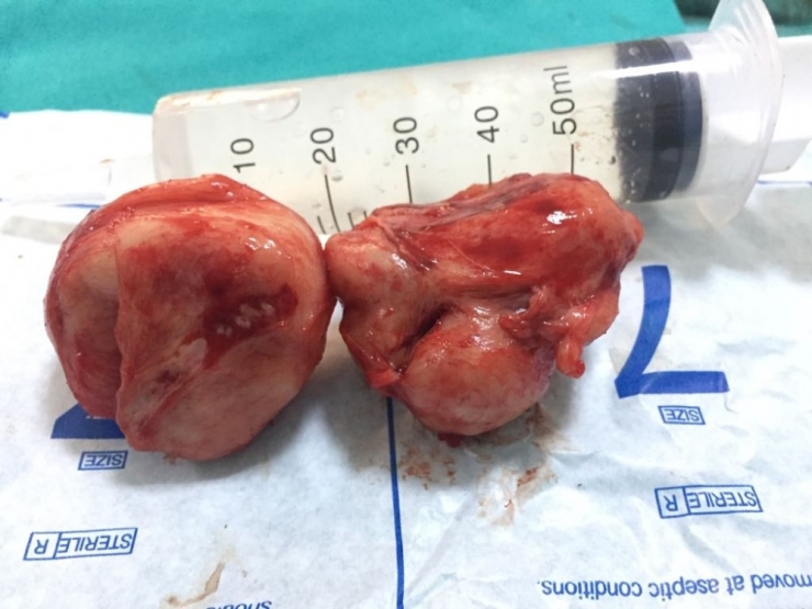 Ameliyatla 200 Gramlık Prostatı Aldılar