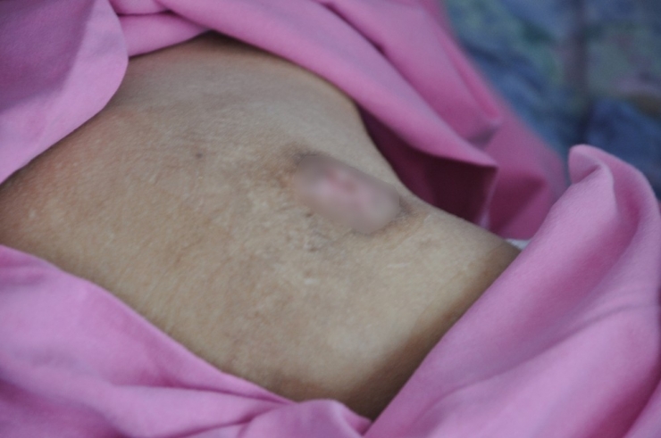 Ameliyatla Kapanmaz Denilen Yaraları Evde Tedaviyle Kapandı