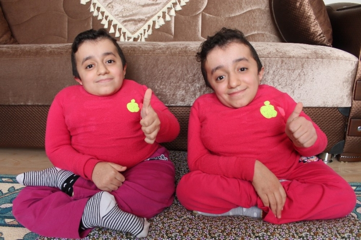 Cam Kemik Hastası İkizlerden Birinin Kemiği Kırılınca Diğeri De Hissediyor