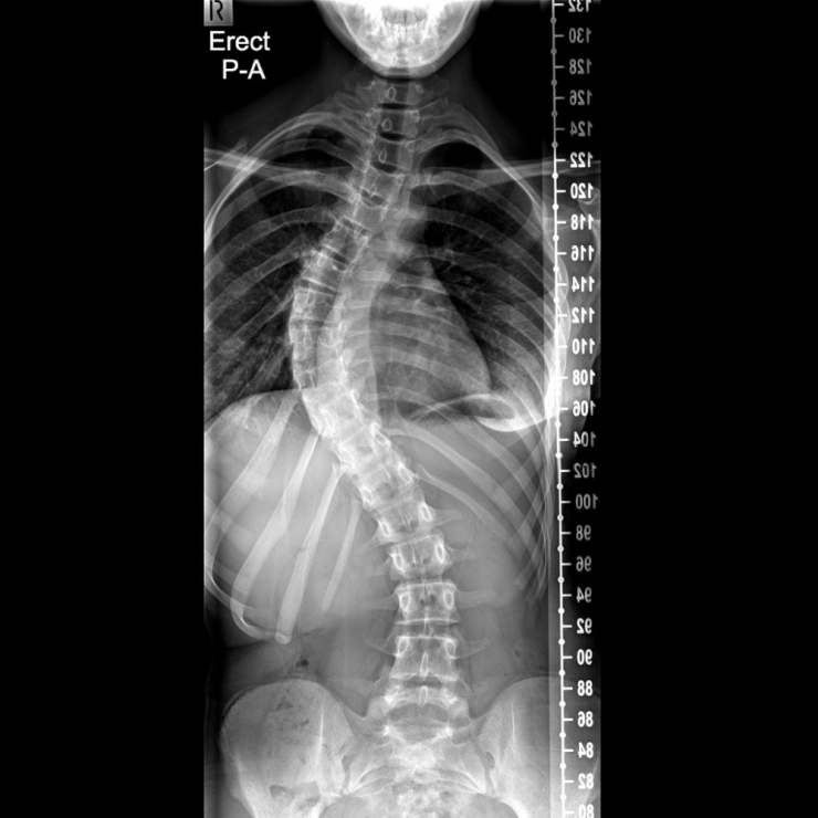 Skolyoz Tedavisinde Geç Kalmayın