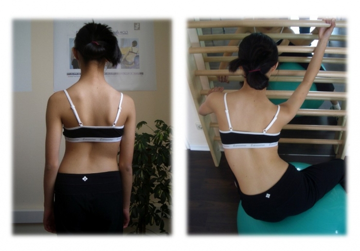 Skolyoz Tedavisinde Geç Kalmayın