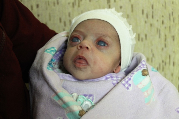 Minik "İkranur" Görmek İçin Destek Bekliyor