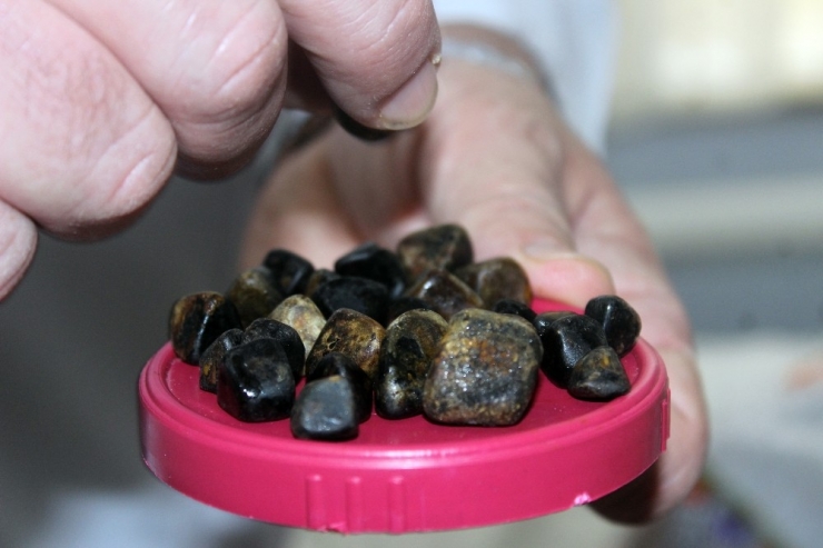 Safra Kesesinden Çıkan Taşlar Doktorları Bile Şaşkına Çevirdi