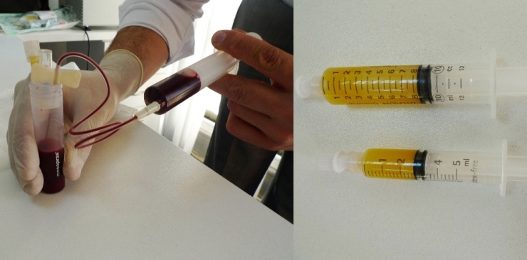 Diz Kireçlenmesinde Prp İle Kök Hücre Tedavisi Karşılaştırması