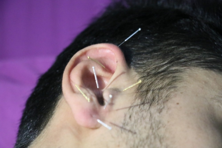 Akupunktur Kısırlığa Çare Oluyor