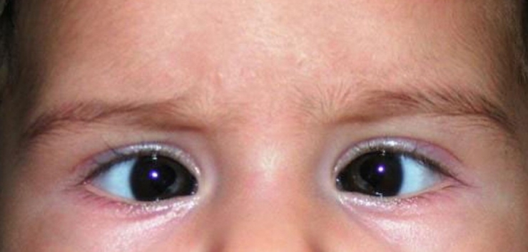 Şaşılık İhmale Gelmez