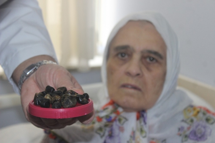 Safra Kesesinden Çıkan Taşlar Doktorları Bile Şaşkına Çevirdi