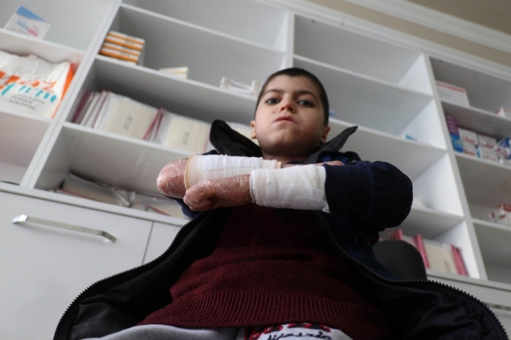 Kelebek Hastası Çocuklar, Kendilerine Uygun Olmayan Köpüklü Sargı Bezini, Derilerine Yapıştığı İçin Kullanamıyor