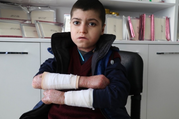 Kelebek Hastası Çocuklar, Kendilerine Uygun Olmayan Köpüklü Sargı Bezini, Derilerine Yapıştığı İçin Kullanamıyor