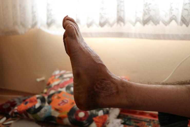 10 Senedir Çektiği Kemik İltihabından Kurtulmak İstiyor