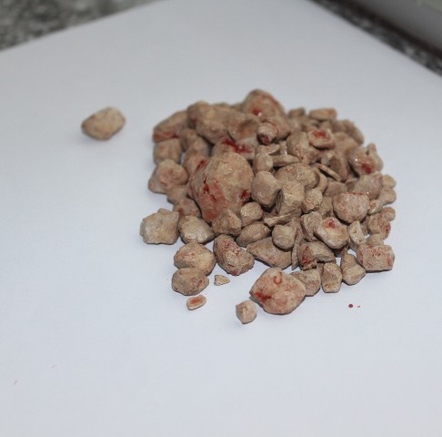 100 Yaşındaki Hasan Amcanın Mesanesinden 136 Adet Taş Çıktı