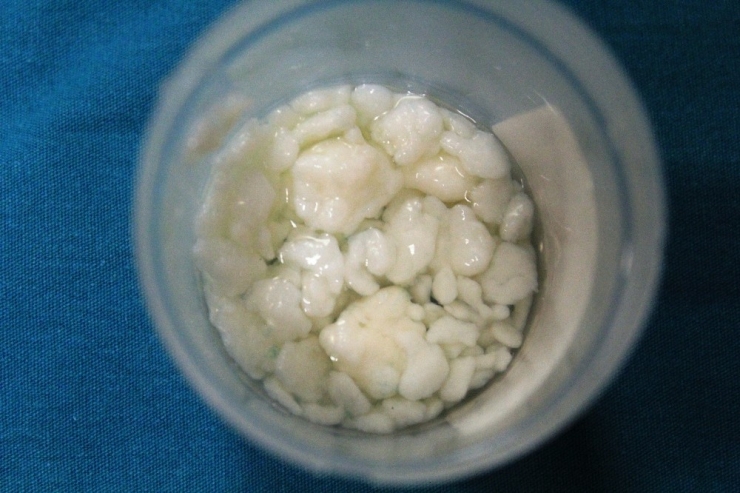 Dizlerinden 967 Tane Eklem Faresi Çıktı