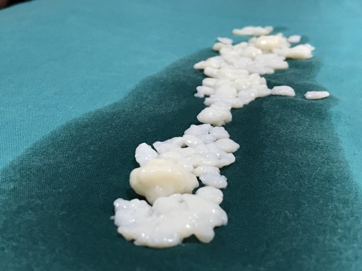 Dizlerinden 967 Tane Eklem Faresi Çıktı