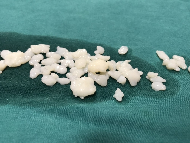 Dizlerinden 967 Tane Eklem Faresi Çıktı