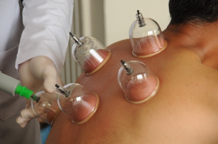 Kupa Terapisi Bağışıklık Sistemini Aktive Ediyor