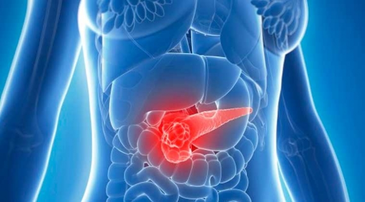 Pankreas Kanserinde Erken Teşhis Önemli