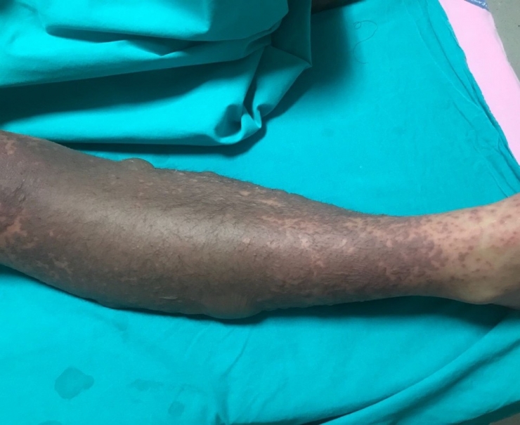 Psikiyatristin Verdiği İlaçla Yoğun Bakımlık Olan Genç Kızdan Sevindirici Haber