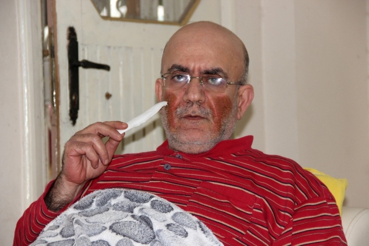 Yüzünde Çıkan Yaralar Nedeniyle Günden Güne Eriyor