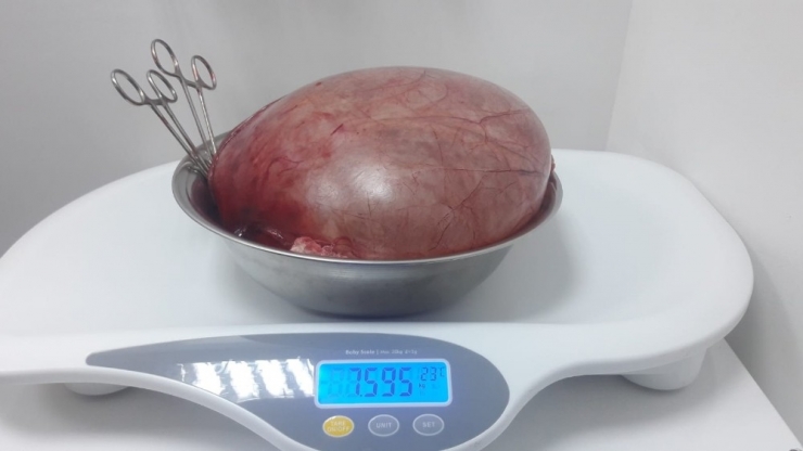 Karnından 7,5 Kiloluk Kist Çıktı
