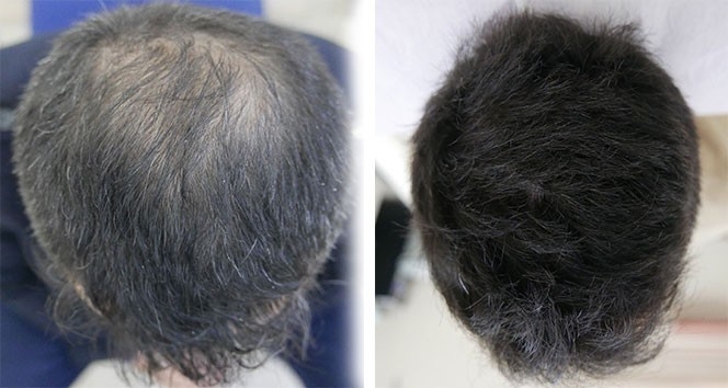 Saç Nakli Tarihe Karışıyor