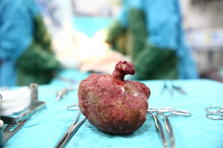 Böbreğinden 12 Santimetre Çapında Taş Çıktı